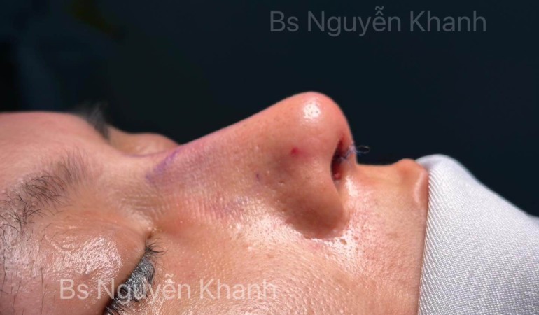 Bác sĩ nhiều kinh nghiệm sẽ biết chọn nâng mũi lót sụn hay cấu trúc cho bệnh nhân