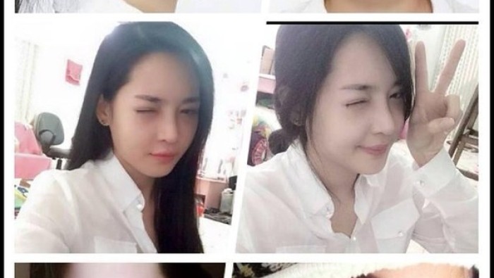 Cô gái Nam Định lột xác toàn diện sau phẫu thuật thẩm mỹ